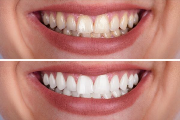 4 خلطات تبييض الأسنان في 5 دقائق سحرية ومجربة